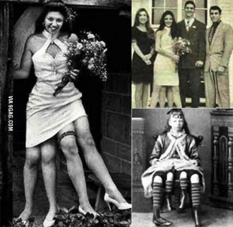 She lived an extraordinary life, facing both triumphs and challenges due to her dipygus condition.